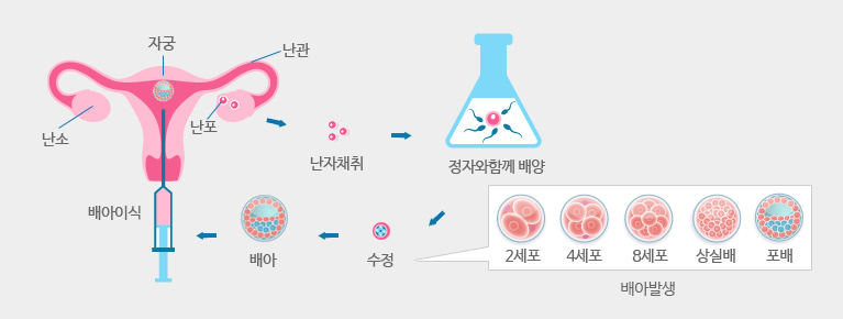 체외수정