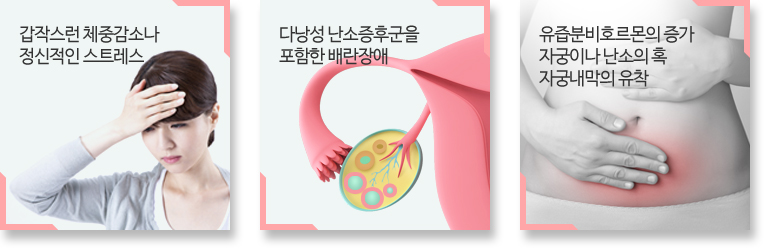 배란장애 원인