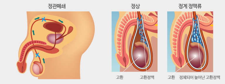 정관폐쇄와 정계정맥류